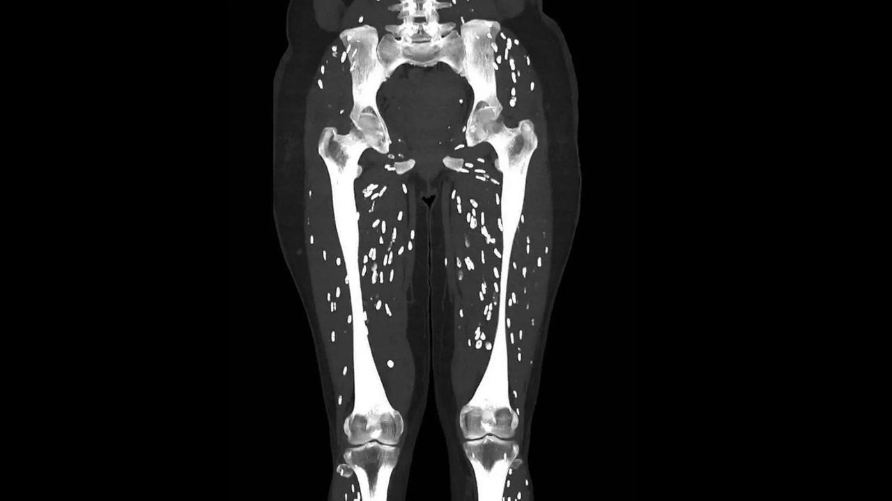 CT scan shows severe parasitic infection from pork tapeworm (Photo Source: @EM_RESUS/X)