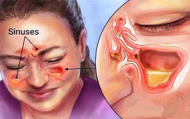 Tips To Treat Avoid Sinus Pain And Infection