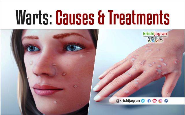 Warts Overview Causes Types Treatment Prevention