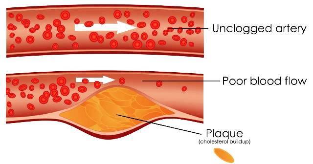 cholesterol-levels