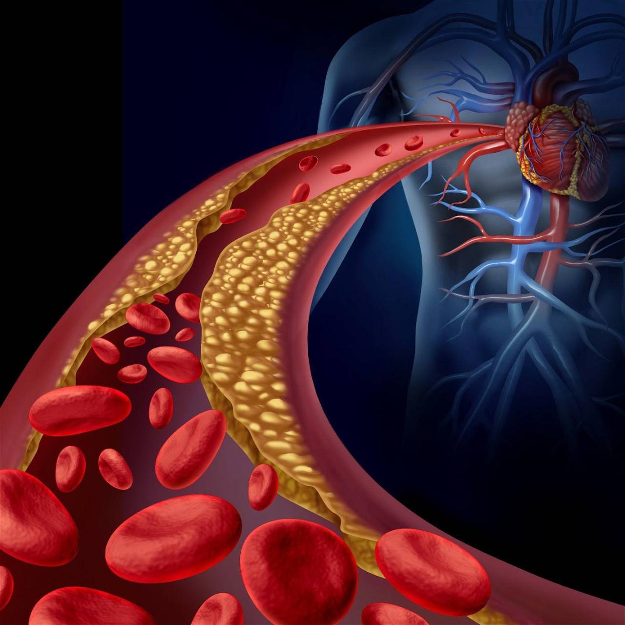 High Cholesterol & Diagnosis