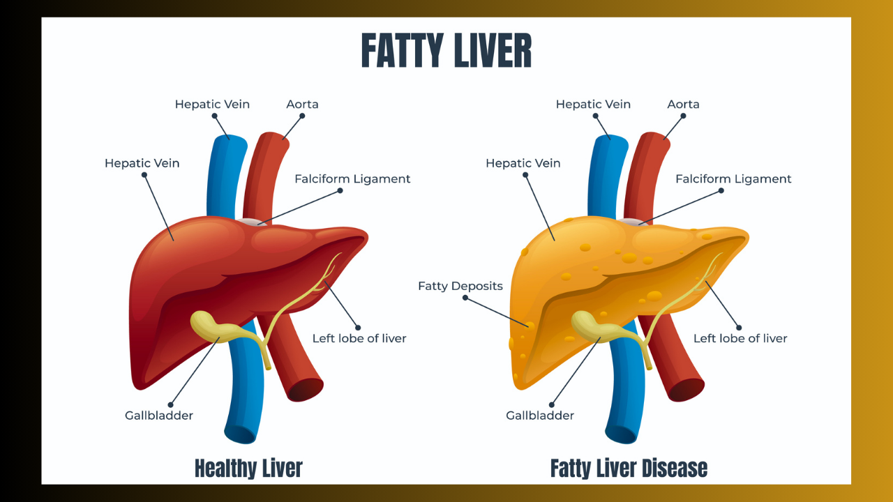 Fatty liver (Photo Courtesy: Freepik)