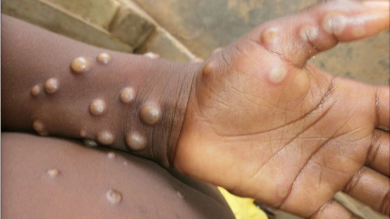 Mpox is a zoonotic disease, spreading from animals to humans via bites, scratches, or handling infected animals. (Photo Source: WHO)