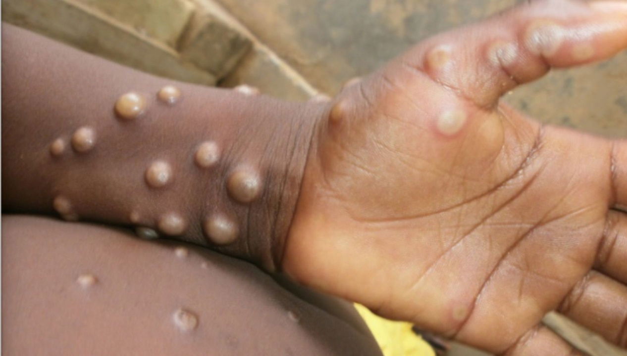 WHO Declares Mpox Outbreak in Africa a Global Public Health Emergency (Photo Source: WHO)